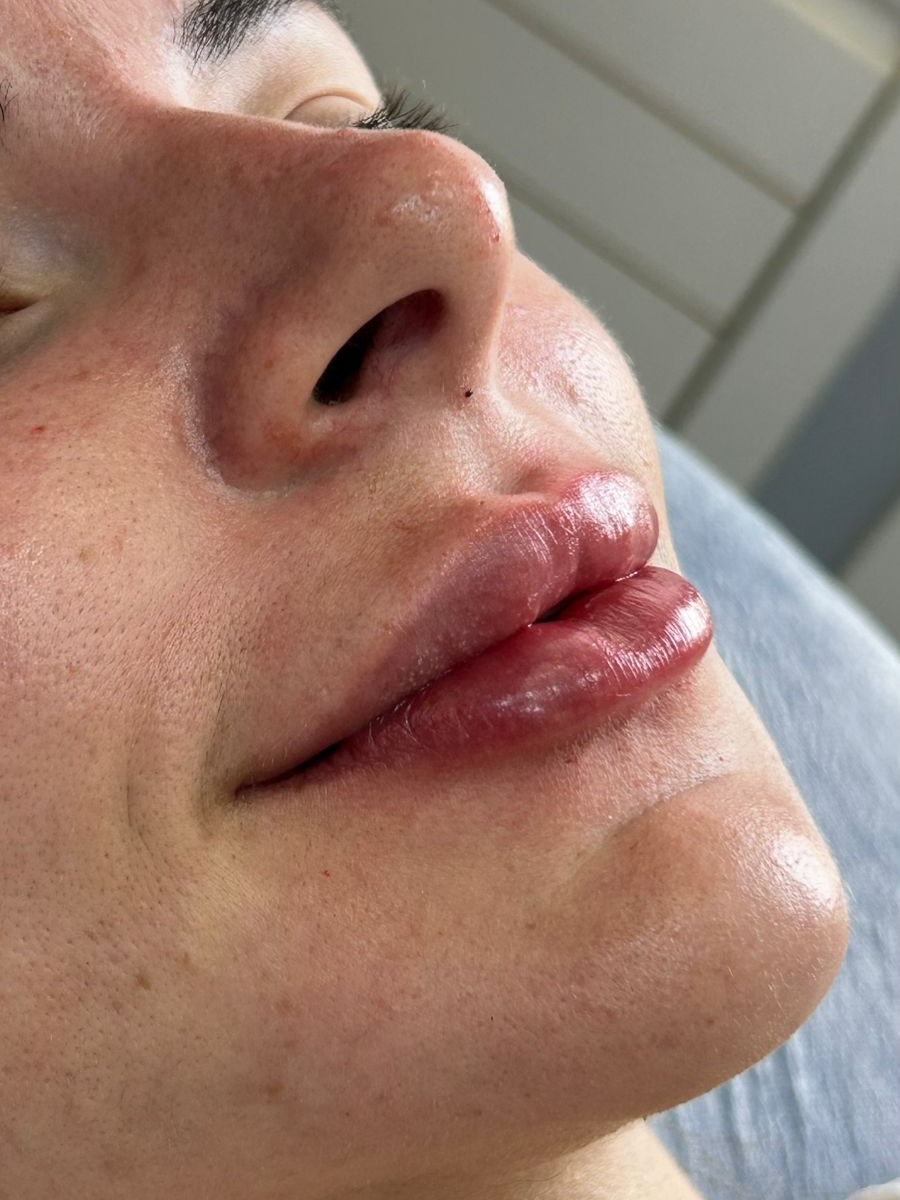 Procedimento estético delicado sendo realizado com precisão