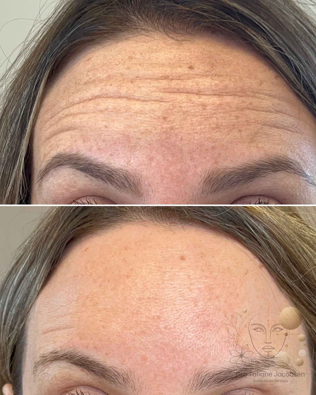 Antes e depois — redução de linhas de expressão na testa